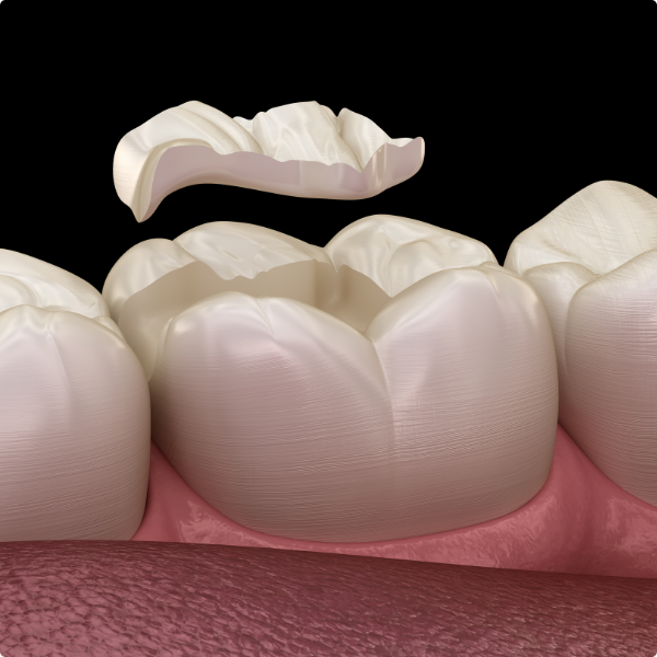 porcelin tooth filling