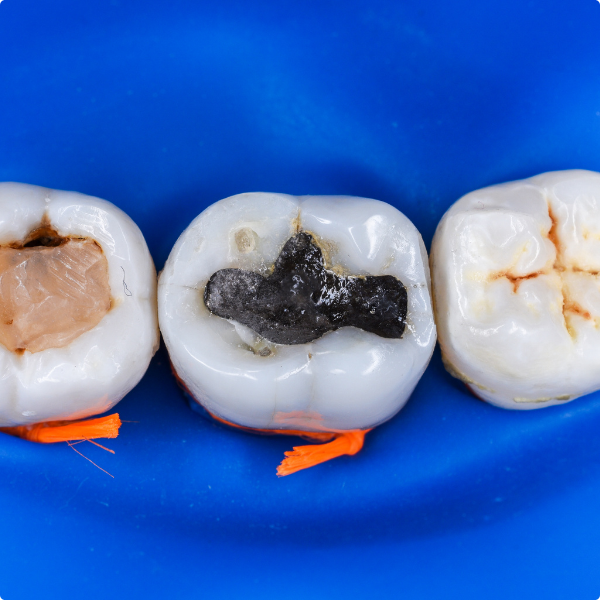 different teeth fillings