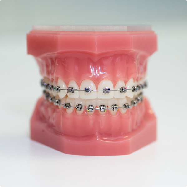 braces on a model of teeth
