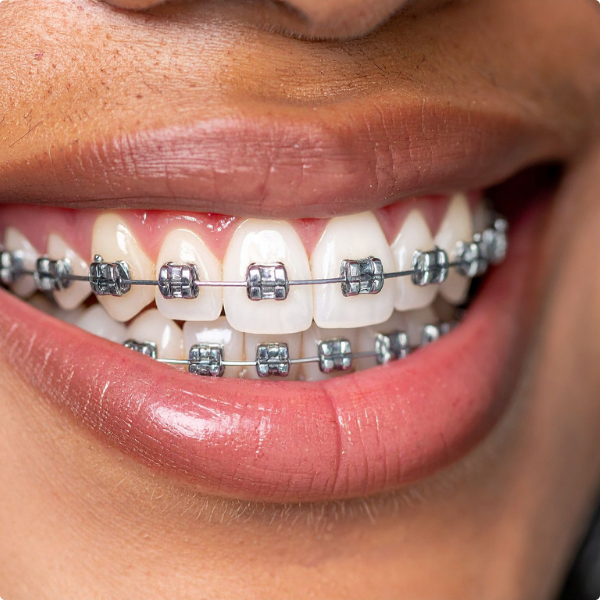 close up of braces