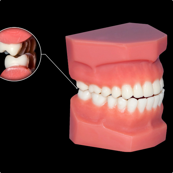 model of teeth showing wisdom teeth
