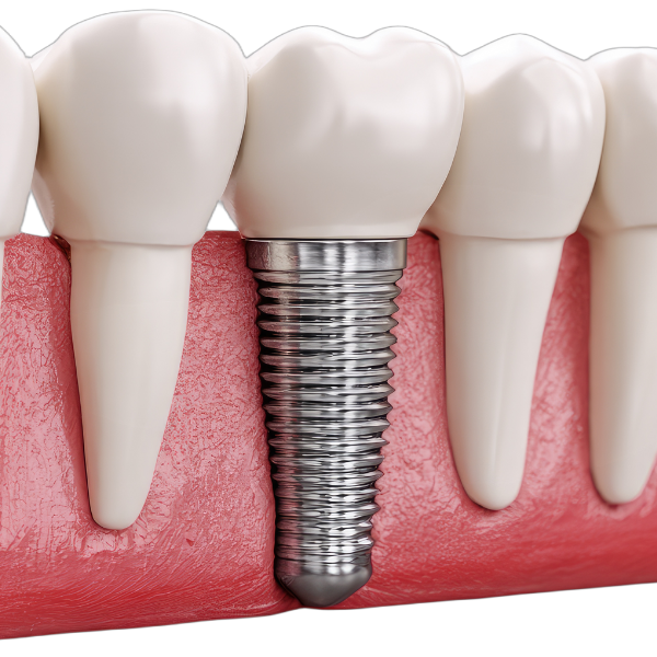 dental implant
